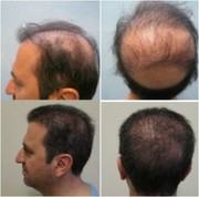 Hair transplant in chandigarh hair loss treatment