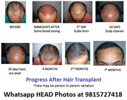 Recovery After FUE Hair Transplant 