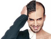 Looking for Best Hair Transplant Clinic in Chandigarh