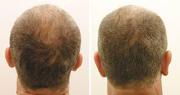 Hair loss treatment in bangalore