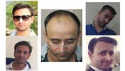 Best Hair Transplant Clinic in Chandigarh