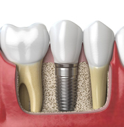 Dental Implants Best Dental Clinic in Greater Kailash