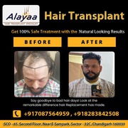 Steps to Prepare for a Best Hair Transplant Clinic in Chandigarh